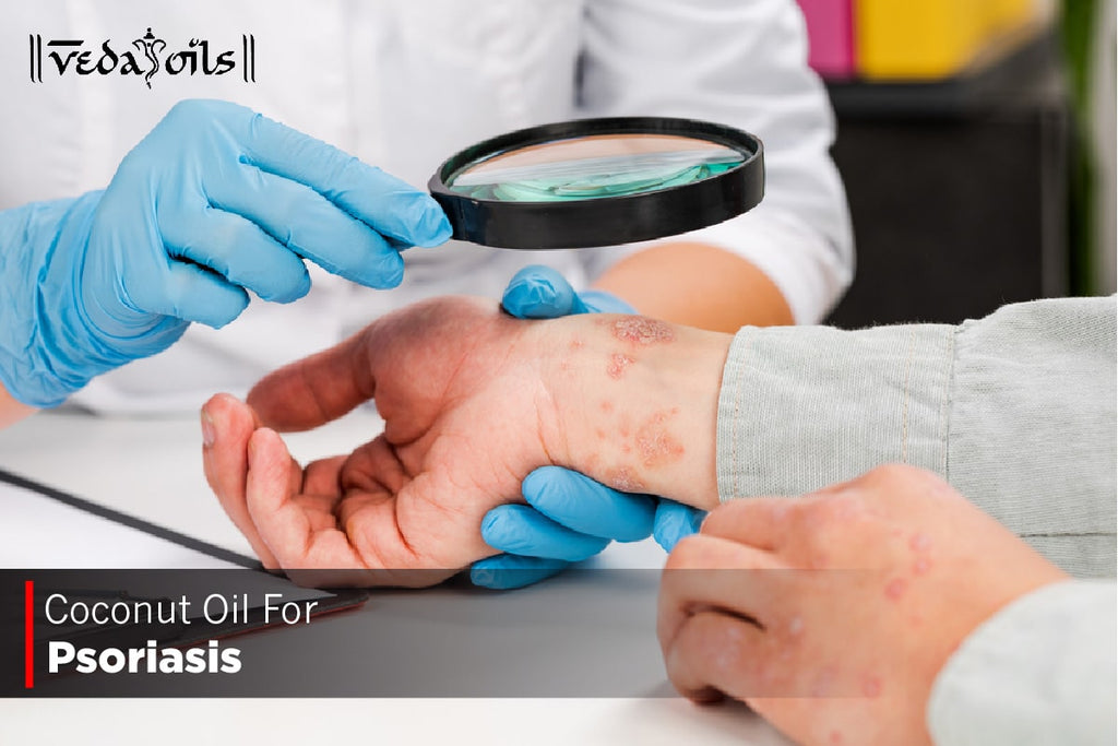 Coconut Oil For Psoriasis Benefits & How To Use VedaOils