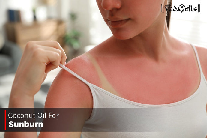 Coconut Oil For Sunburn Relief - How To Use?