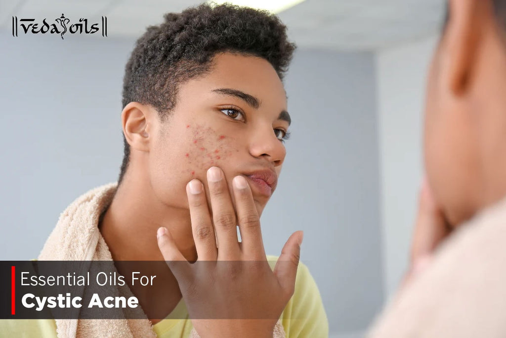 8 Best Essential Oils For Cystic Acne Treatment VedaOils