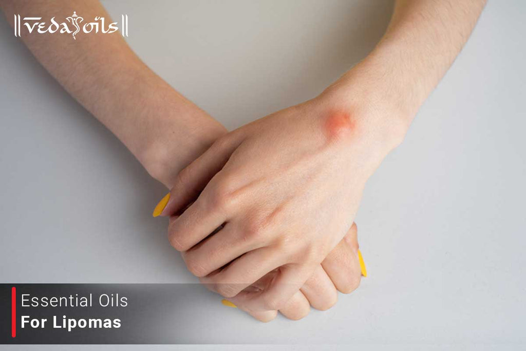 8 Best Essential Oils For Lipomas VedaOils