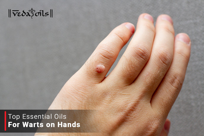 Essential Oils for Warts | Best Antiviral Oils for Periungual Warts Removal