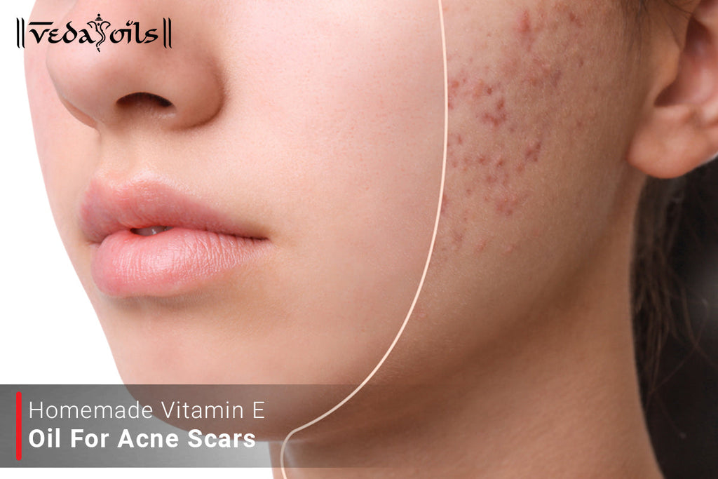 Vitamin E Oil For Acne Scars Is It Effective For Scar Treatment