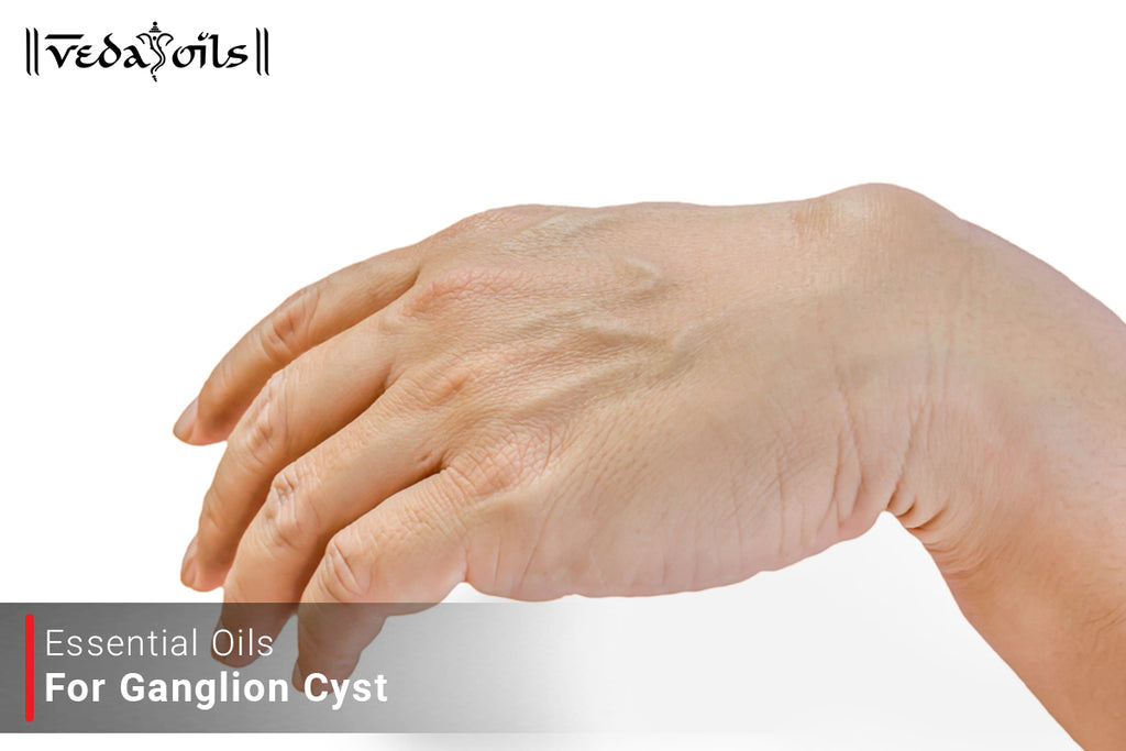 6 Best Essential Oils For Ganglion Cyst Natural EO For Ganglion Cyst VedaOils