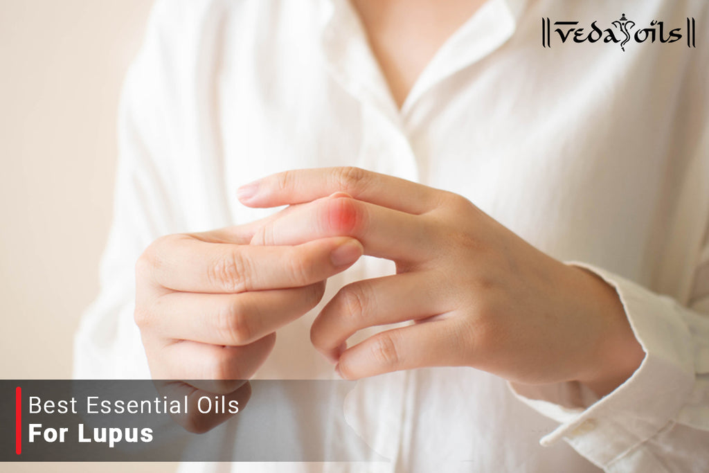 5 Best Essential Oils For Lupus VedaOils
