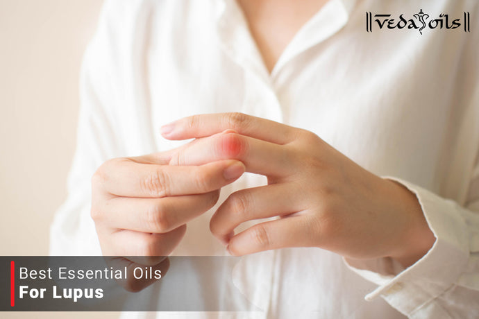 Essential Oils For Lupus - Systemic Lupus Erythematosus