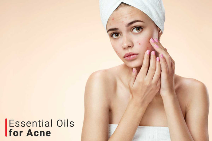 Essential Oils For Acne Scars | Anti Acne and Pimples Oil