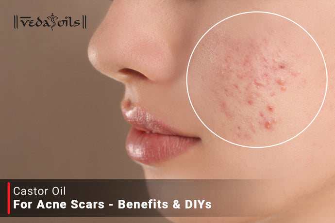 Castor Oil For Acne Scars | DIY Recipes For Pimple Marks