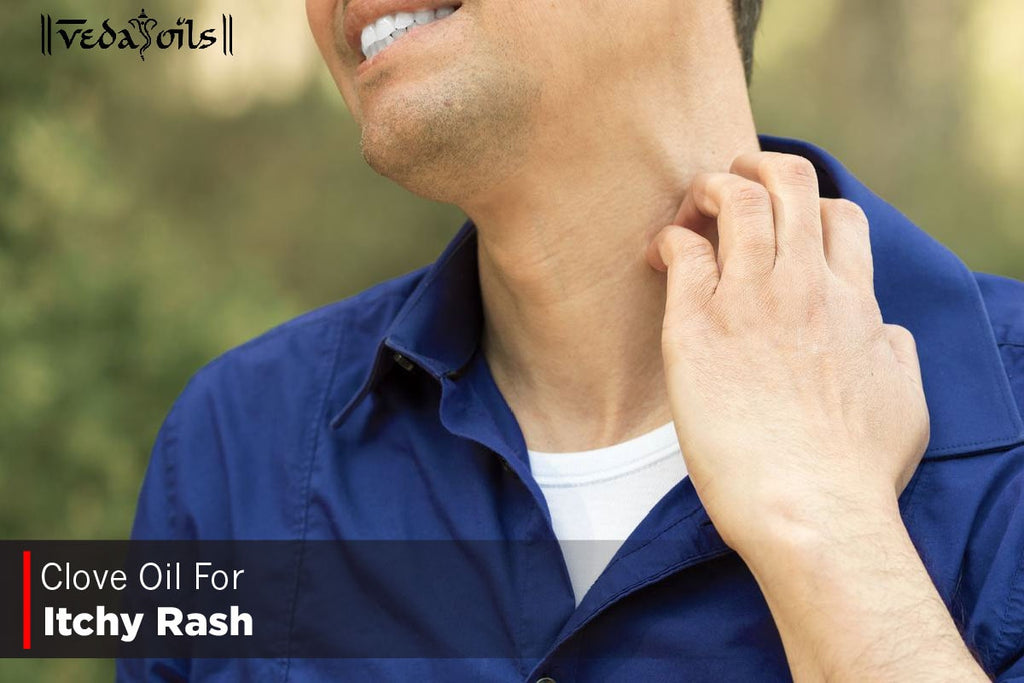 Oil For Rashes Clove Oil For Itchy Rashes - Benefits & How To Use? – VedaOils
