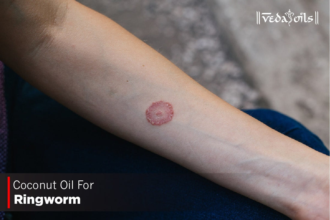 Coconut Oil For Ringworm