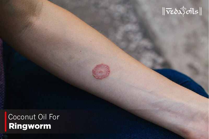 Coconut Oil For Ringworm - How To Use It?
