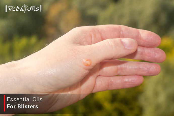 Essential Oils For Blisters - Fever Blister Treatment Oils
