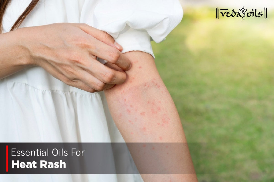 Essential Oils For Heat Rash
