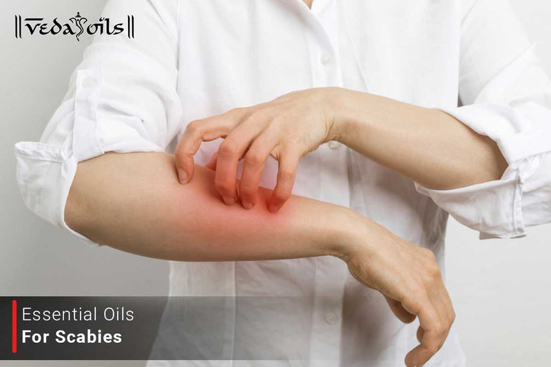 How Essential Oils Can Help Treat Scabies Naturally