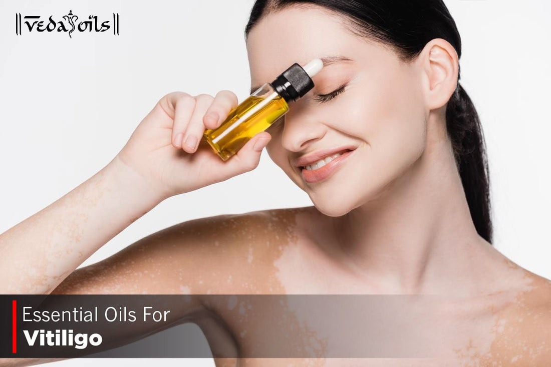 Essential Oils For Vitiligo