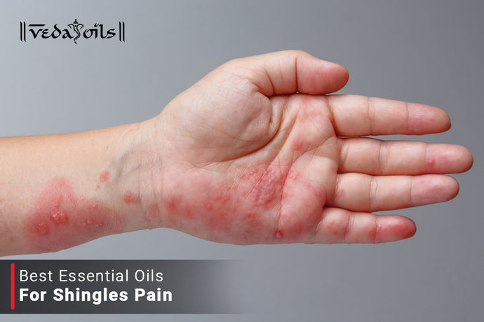 Essential Oils for Shingles - Natural Treatment