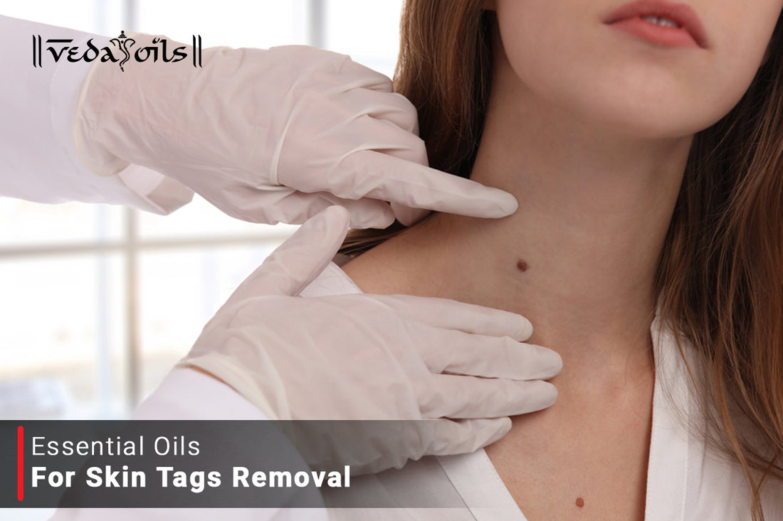 Essential Oils for Skin Tags