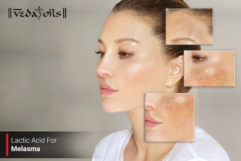 Lactic Acid for Melasma - Benefits, Uses & DIY Remedy for Dark Spots