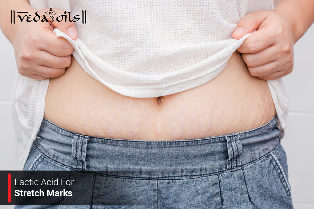 Lactic Acid For Stretch Marks