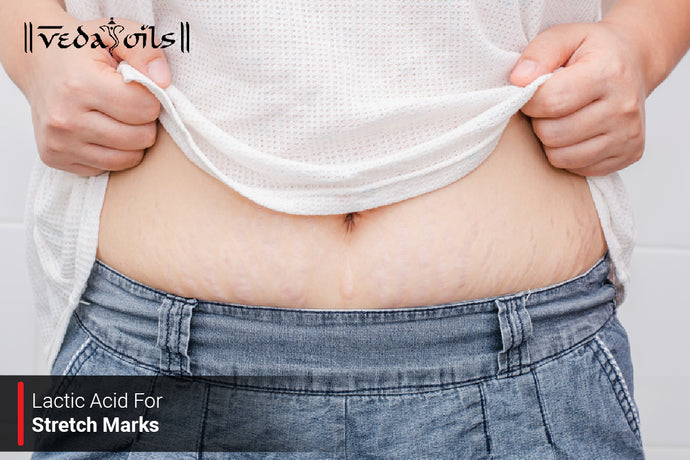 Lactic Acid For Stretch Marks - Is Lactic Acid Good For Stretch Marks?