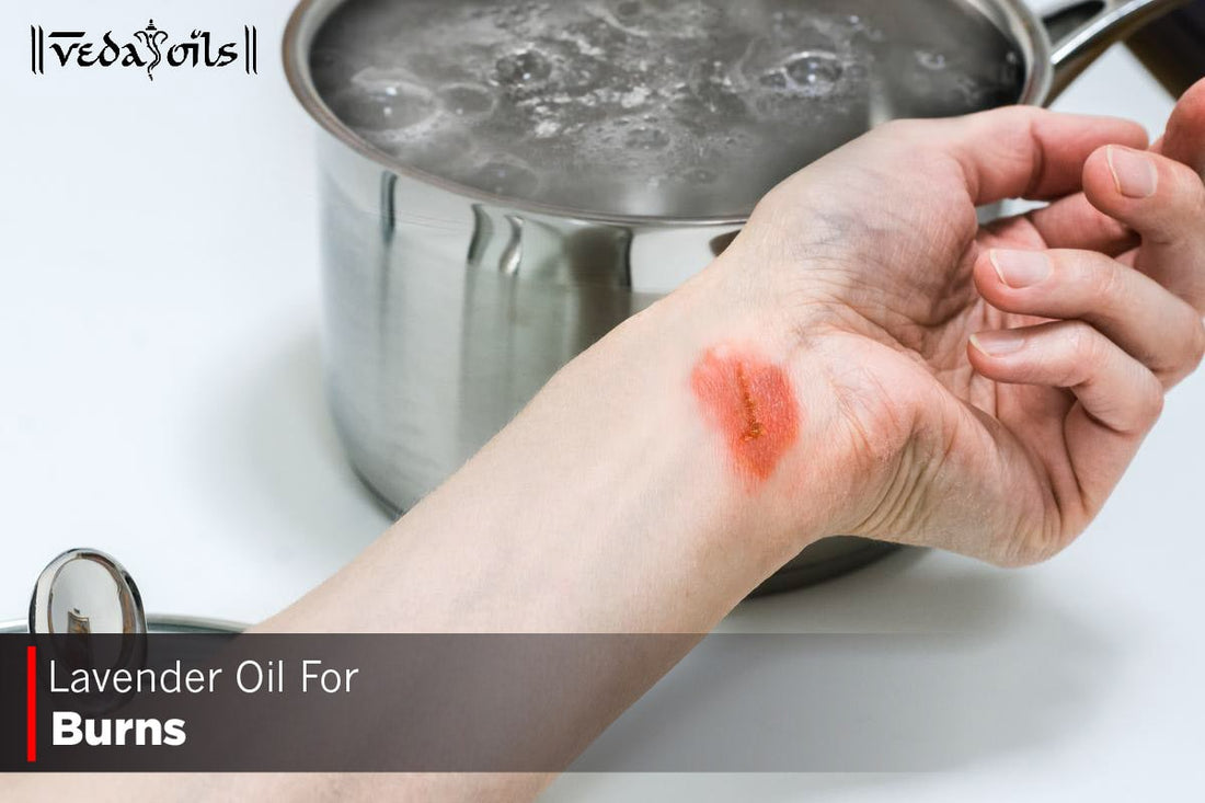 Lavender Oil For Burns