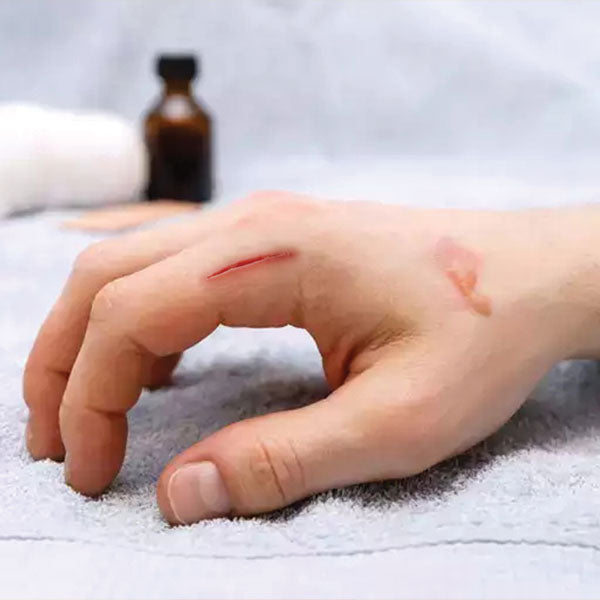 Essential Oils For Cuts and Wounds | Antiseptic Oils For Scrapes