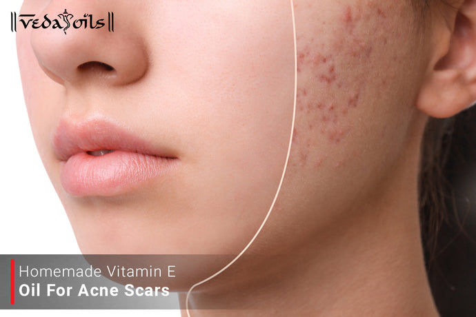 Vitamin E Oil For Acne Scars - Is It Effective For Scar Treatment?