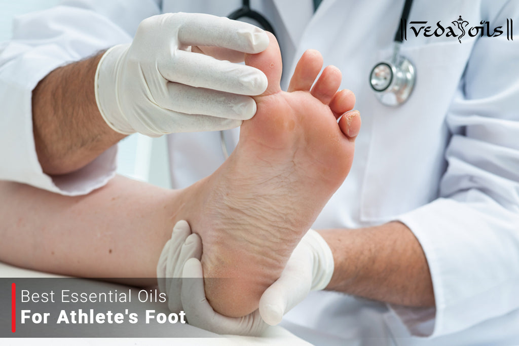 8 Best Essential Oils For Athlete's Foot VedaOils