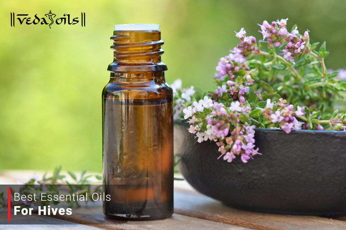 essential oils for hives